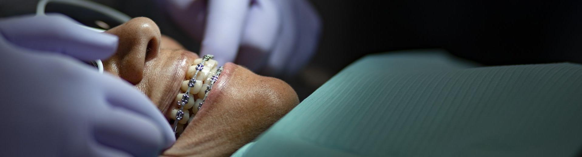 戴着紫色乳胶手套的牙医正在给戴着牙套的正畸病人治疗.